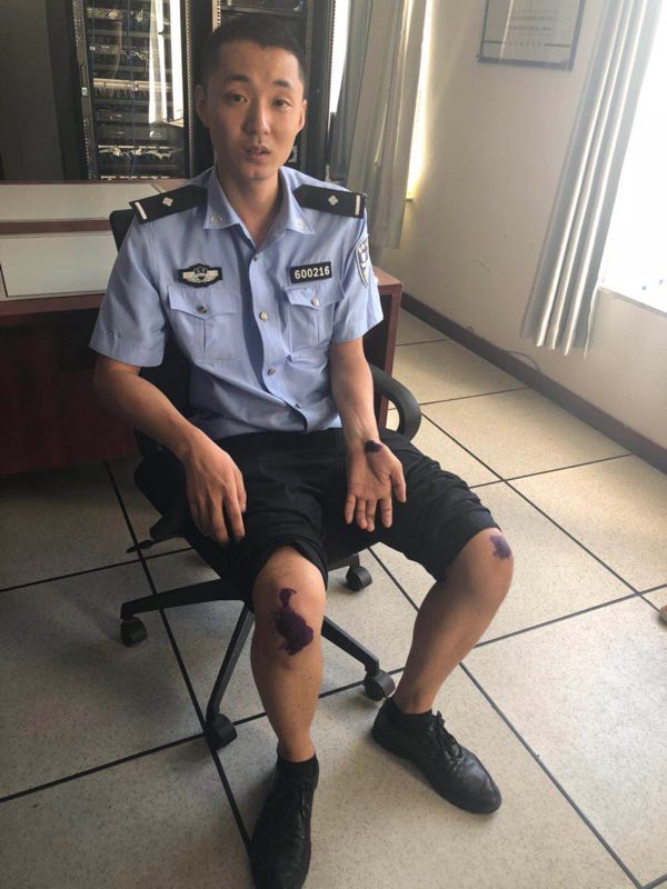 手脚受伤